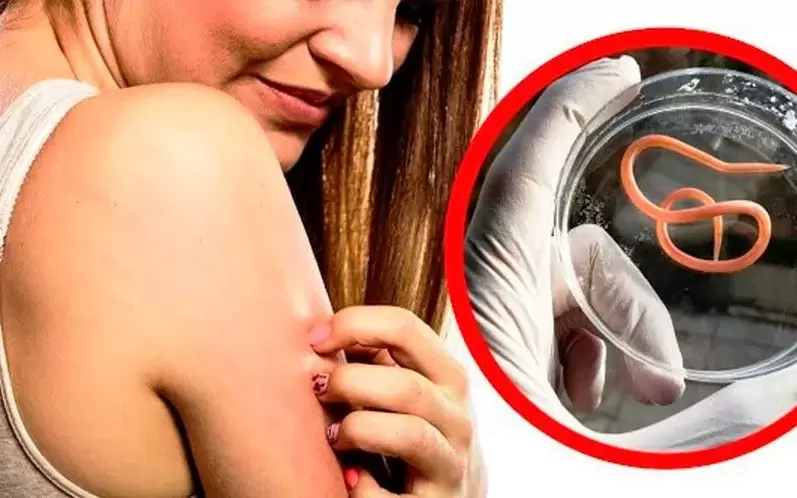 itching and irritation caused by parasites in the body