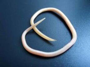 Human roundworm is extracted from the body