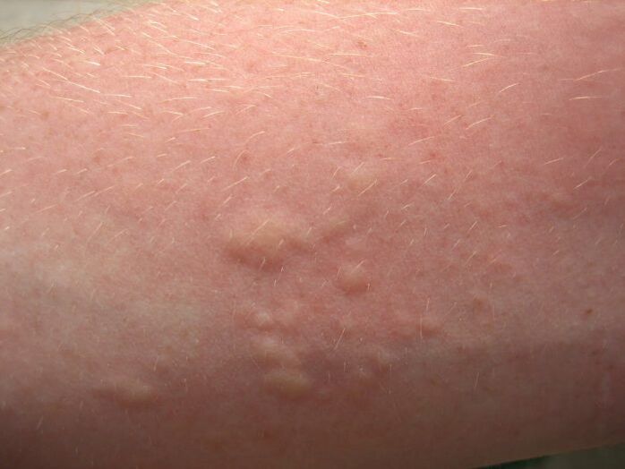 Itchy allergic skin rash can be a symptom of ringworm