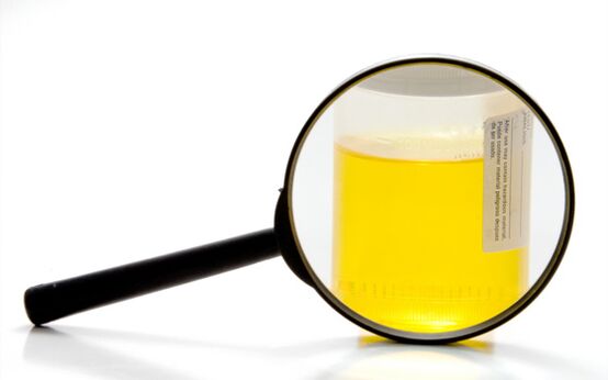 Urine test to diagnose schistosomiasis