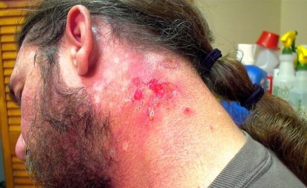 Bleeding wound on neck caused by Morgellons virus