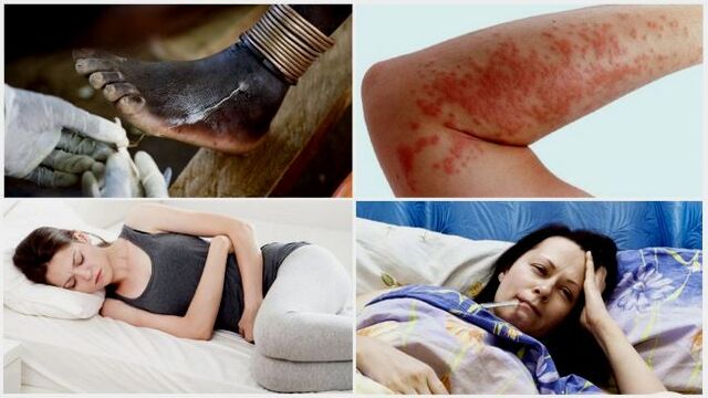 Common symptoms of parasitic infections under the skin