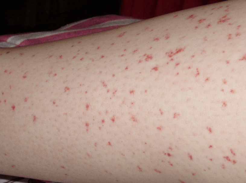 Skin rash is a sign of acute worm infection